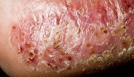 Dermatomykoza