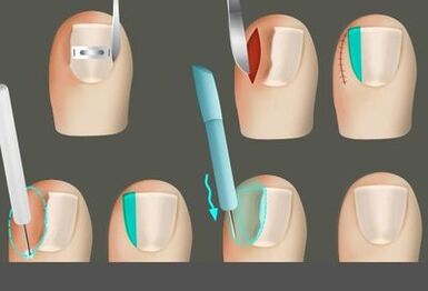 Uklanjanje nokta u prisutnosti gljive na nogama