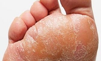 Znakovi i simptomi gljivica na nogama