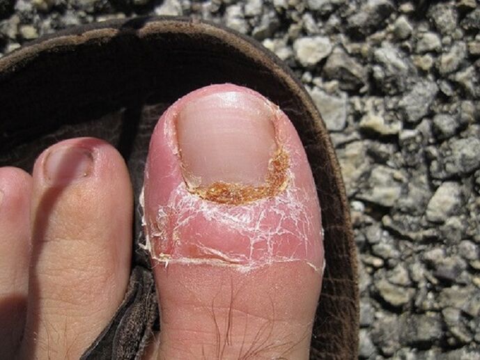oštećenje noktiju i kože nožnih prstiju zbog gljivične infekcije